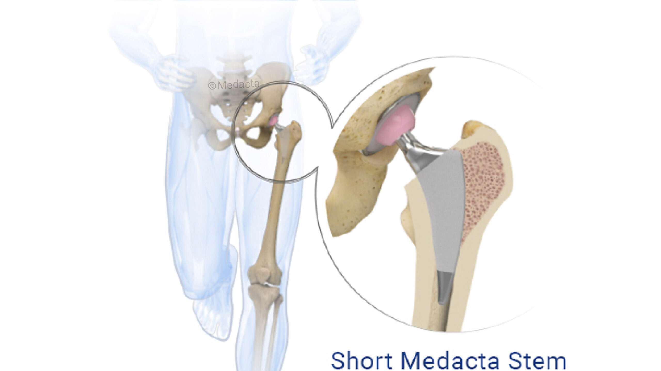 Anterior Minimally Invasive Hip Surgery