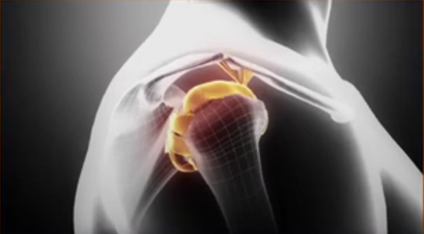 Animation: MICRORAPTOR Knotless Suture Anchor for Shoulder